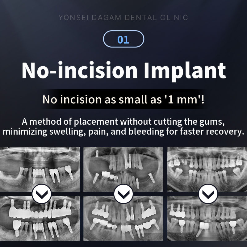 Non-incisional implants, full implants