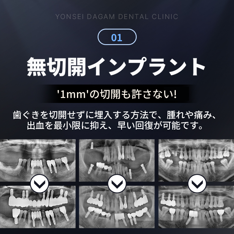 無切開インプラント、全体インプラント