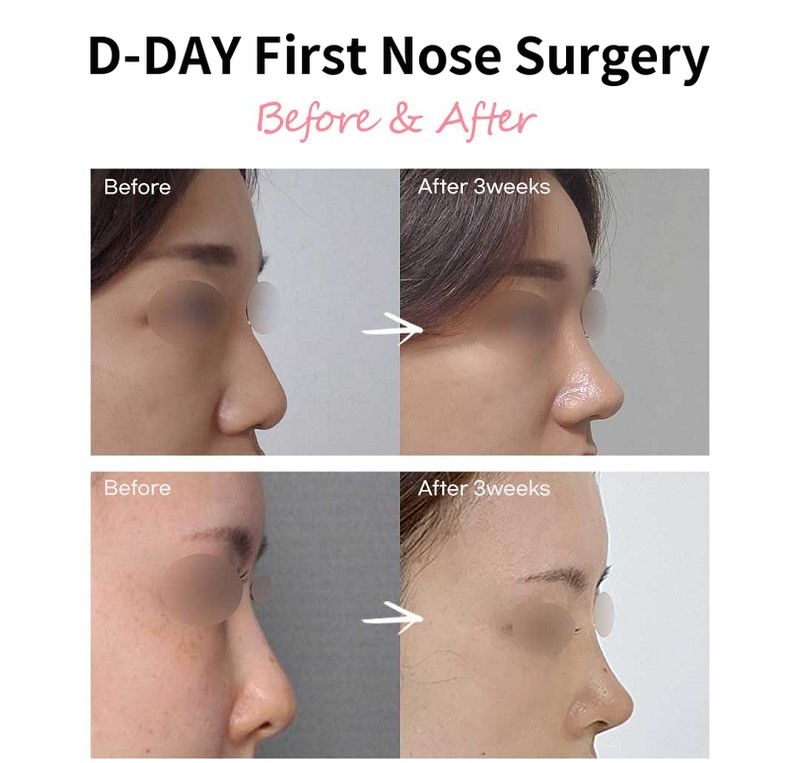 D-Day for Korean! First D-Day Plastic Surgery!