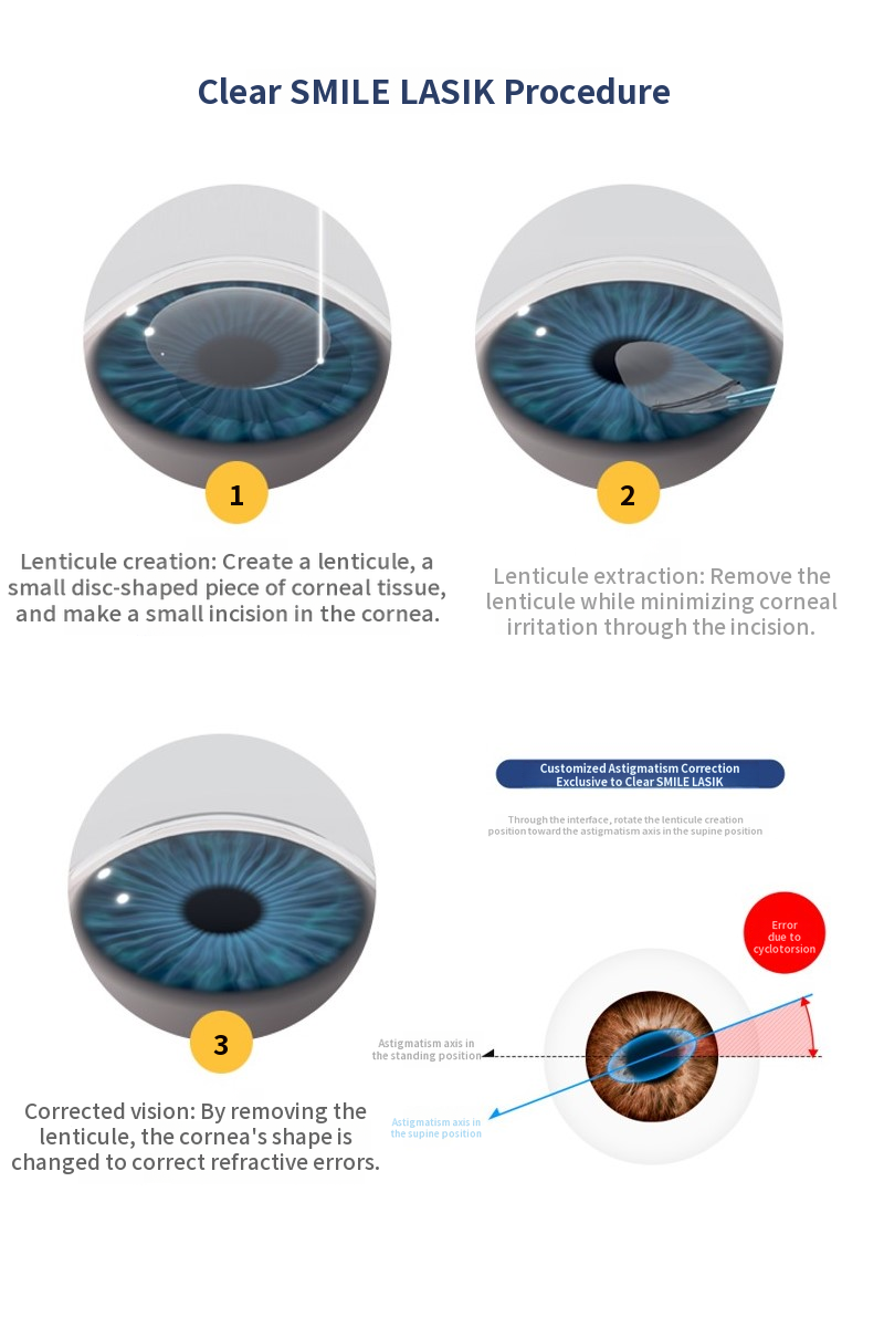Clear SMILE LASIK