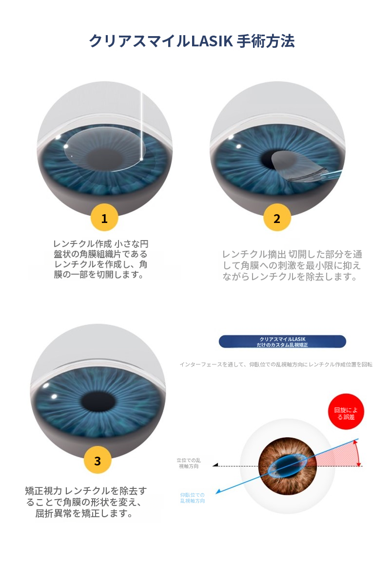 クリアスマイルレーシック