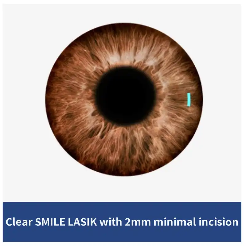 Clear SMILE LASIK