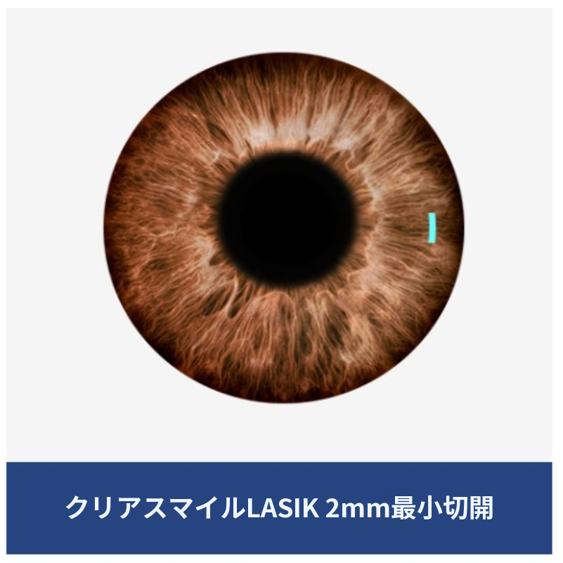 クリアスマイルレーシック