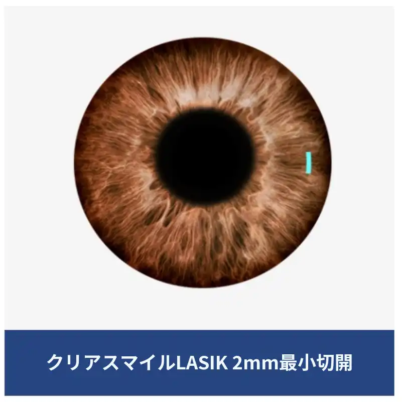 クリアスマイルレーシック
