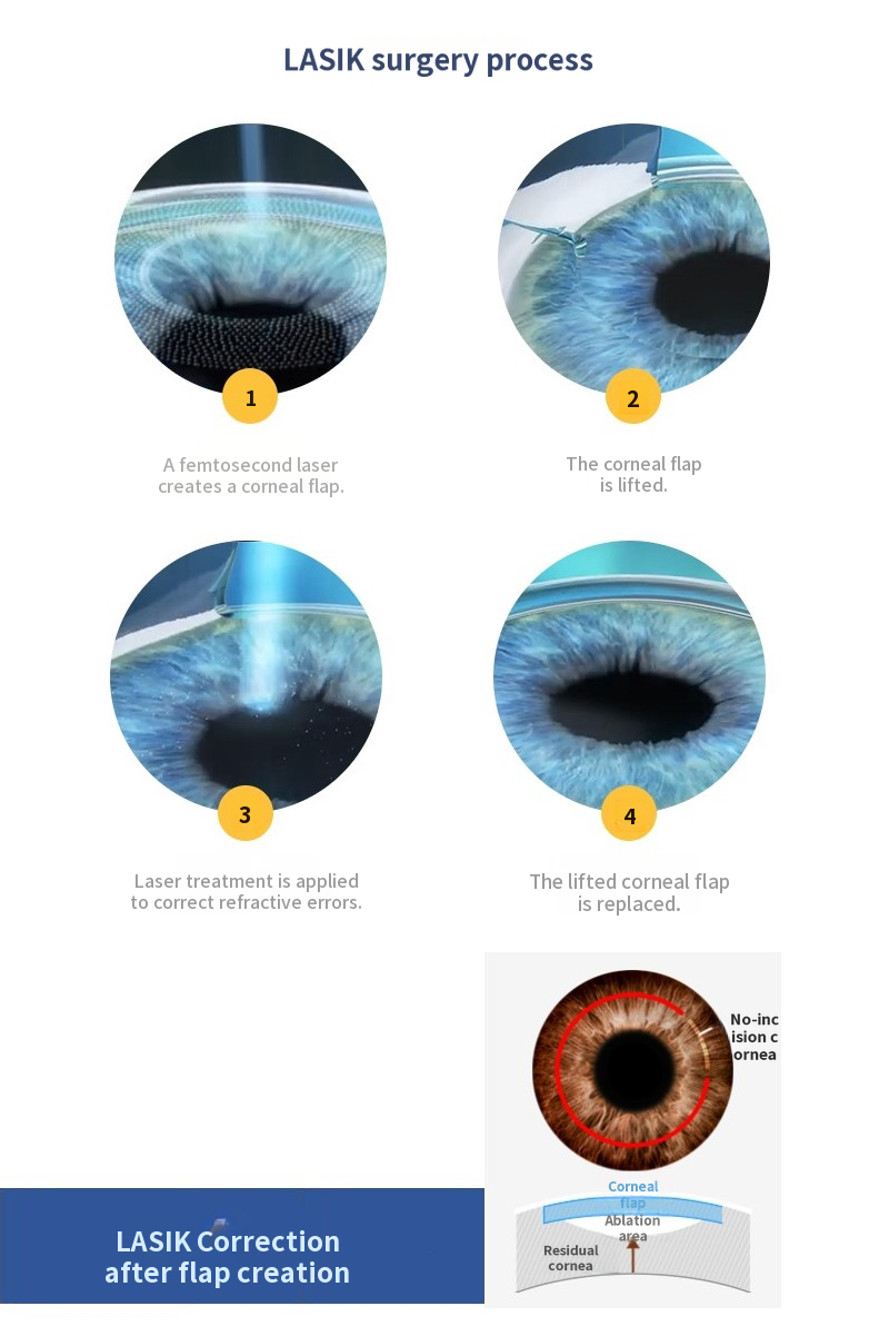 Z8 LASIK