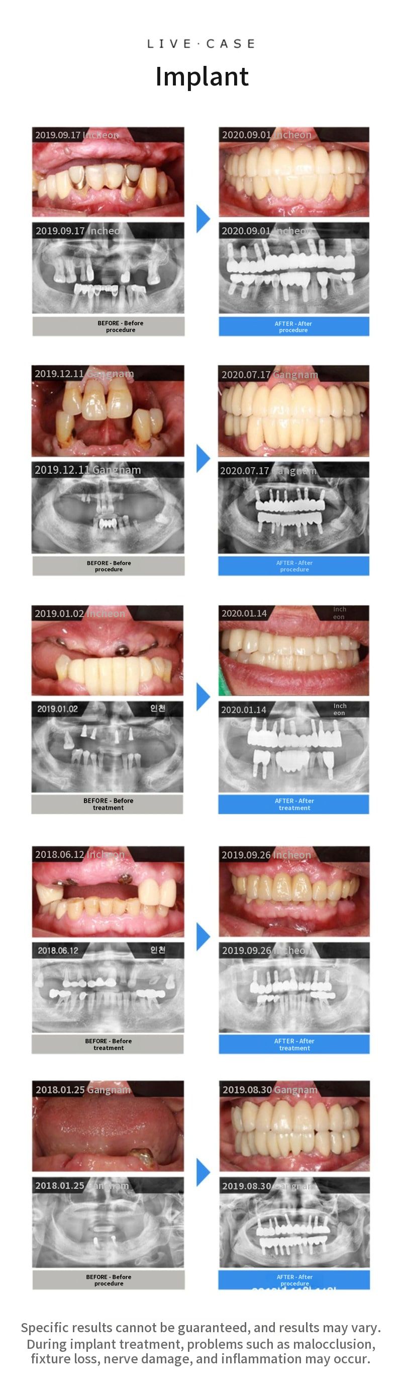 Single-jaw full-arch dental implants, special price with payment in 4 installments