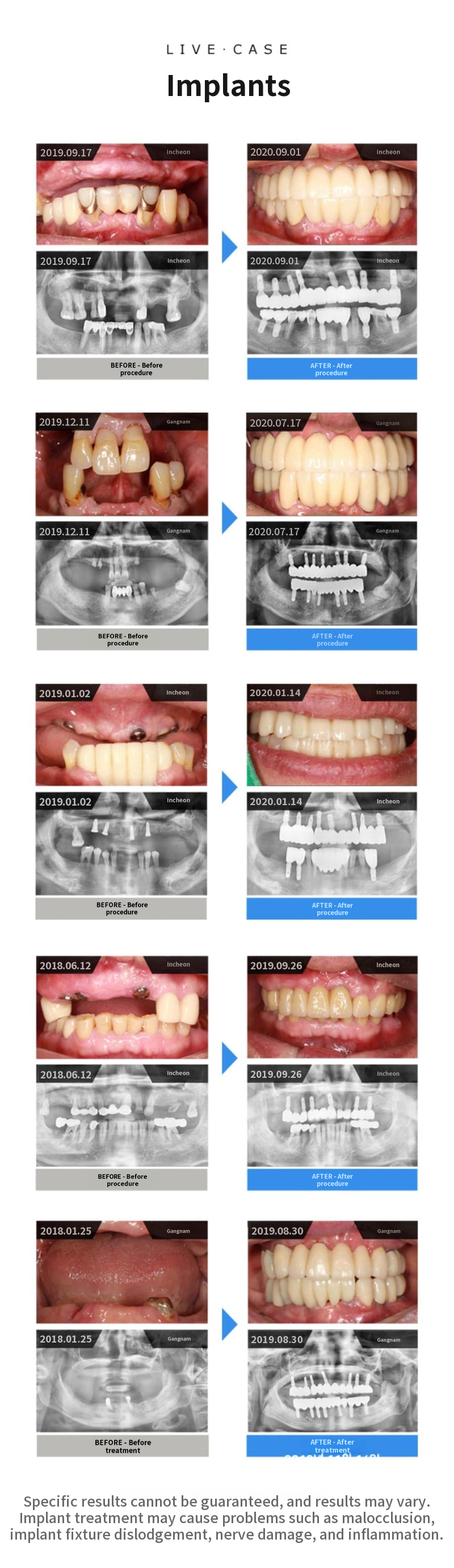 Full-Arch Dental Implants for One Jaw – Special Price with 4 Installment Payments