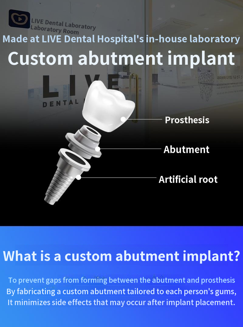 Single-jaw full-arch dental implants, special price with payment in 4 installments