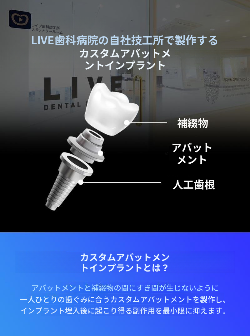 片顎フルアーチインプラント4回分割払い特別価格