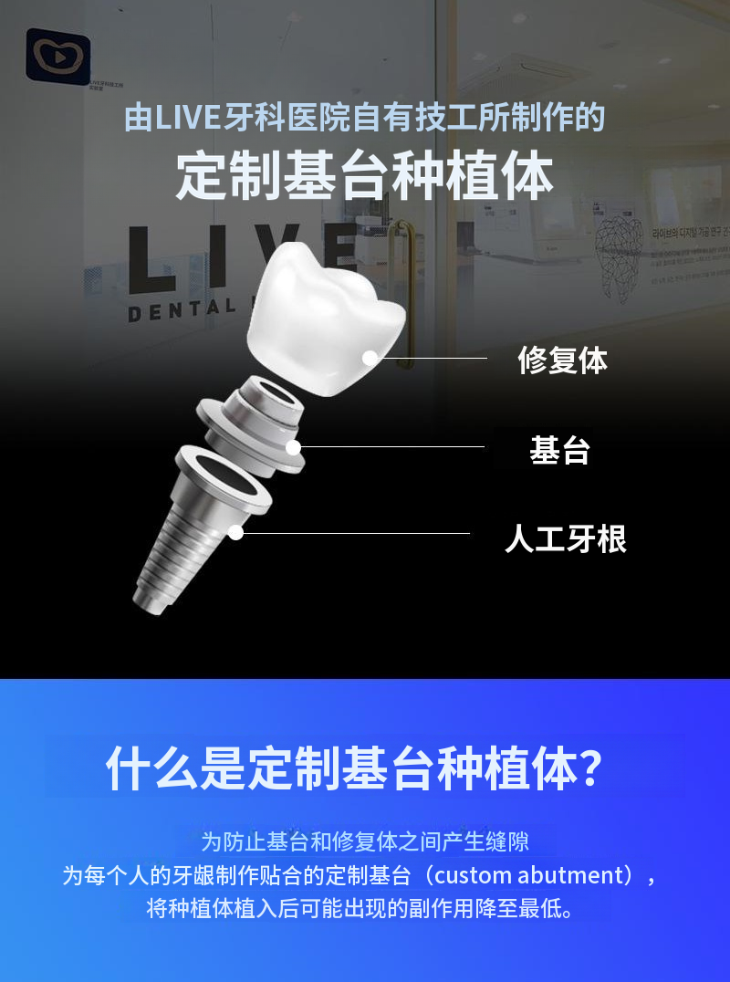 单颌全口种植牙，分4期付款特价