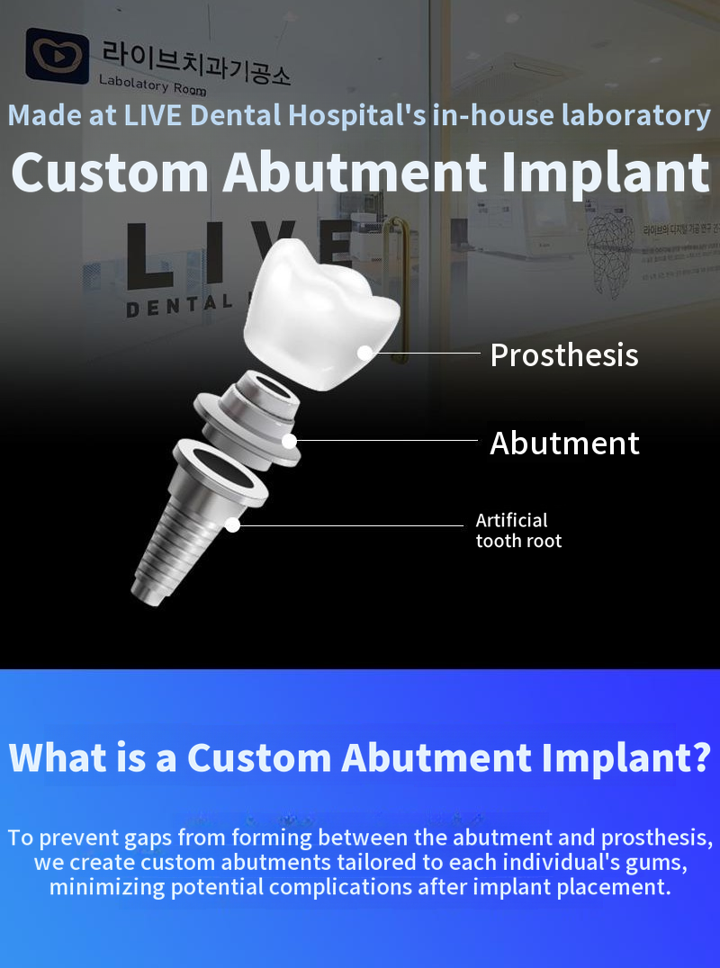 Full-Arch Dental Implants for One Jaw – Special Price with 4 Installment Payments