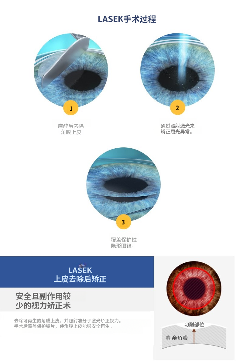 高端LASEK