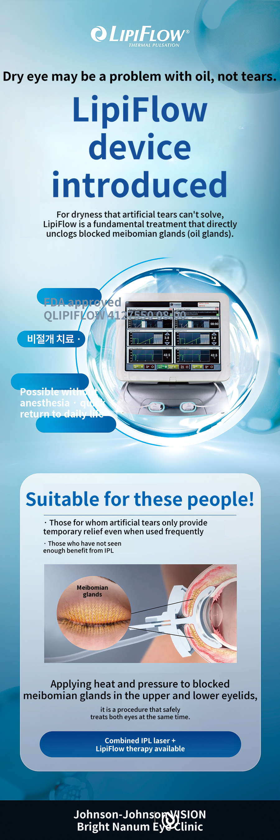 OptiLight IPL Photofacial for Dry Eye Disease