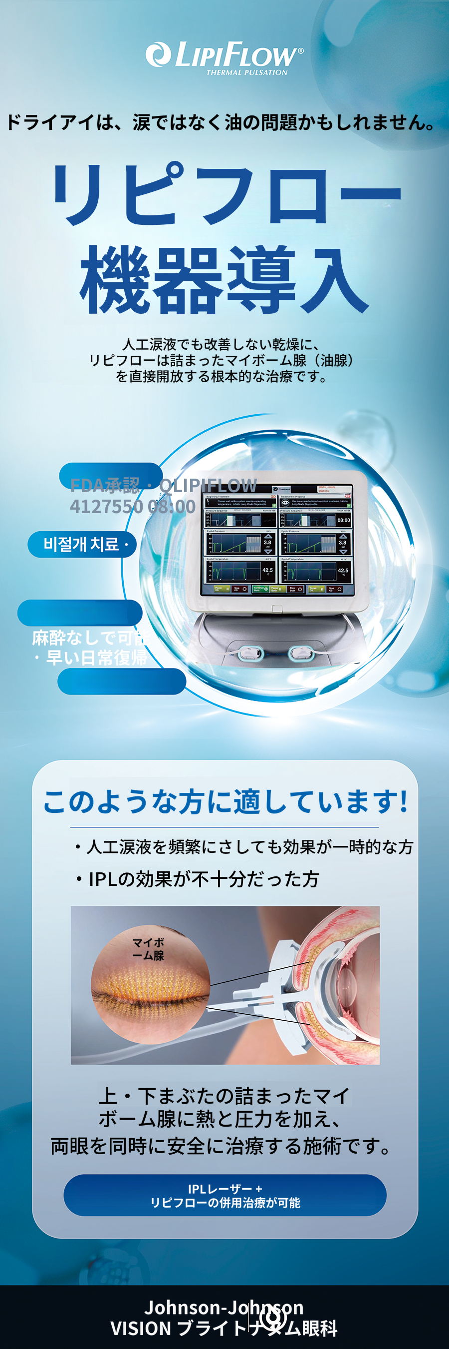 ドライアイ IPLオプティライト