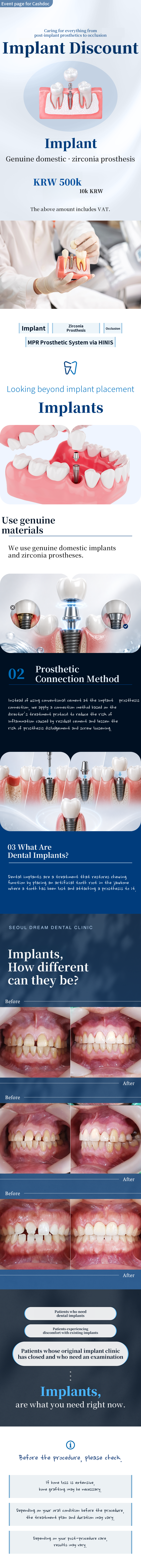 Dental Implants