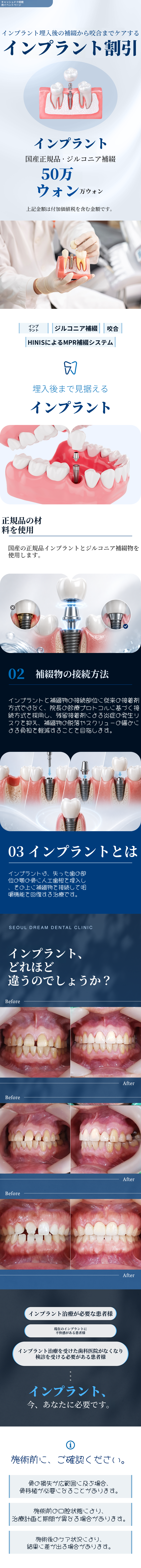 インプラント
