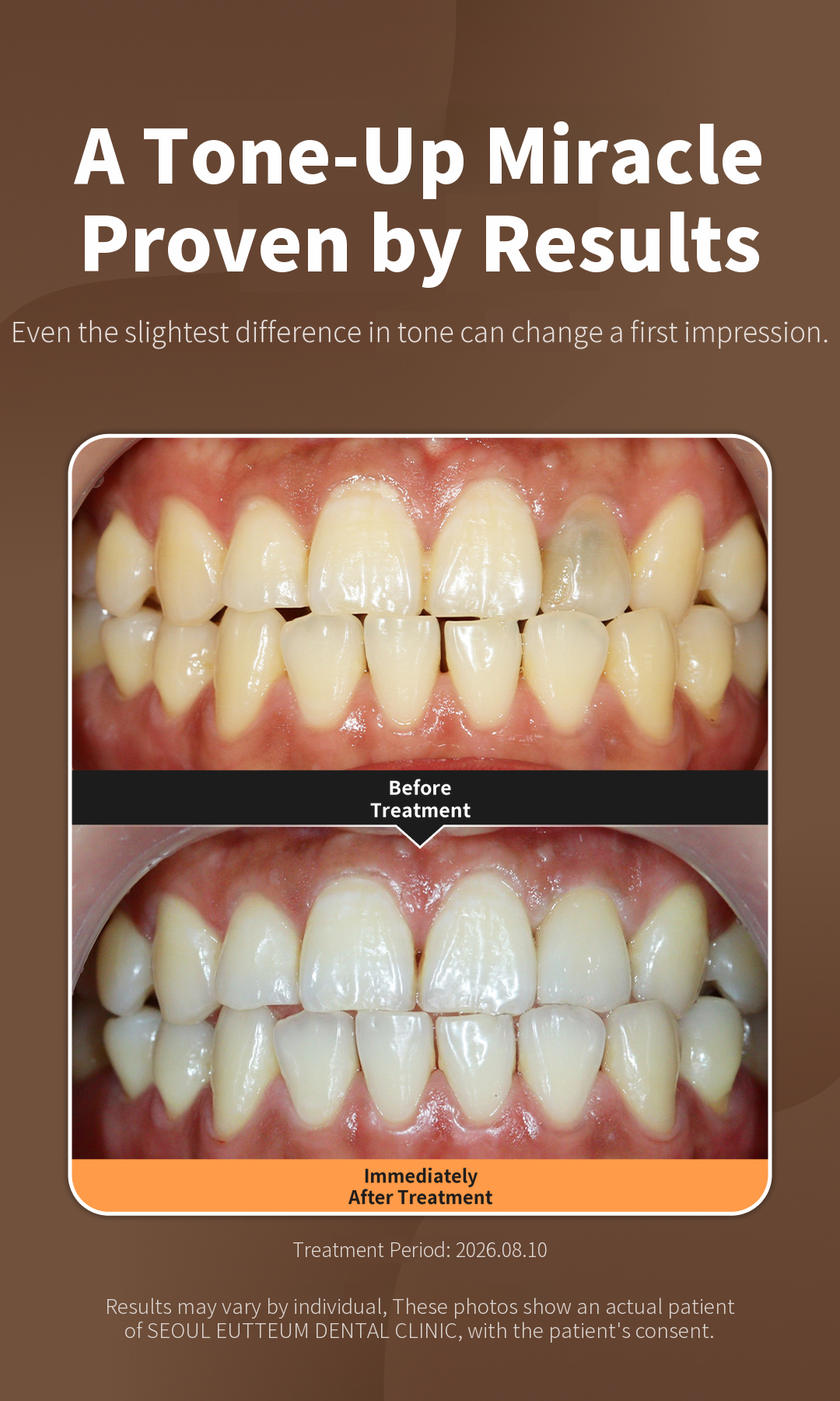 Teeth Whitening