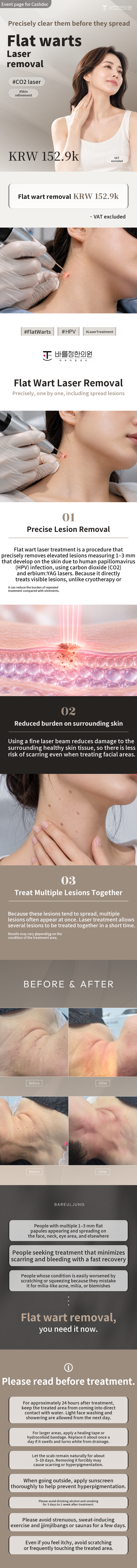 Flat Wart Laser Removal