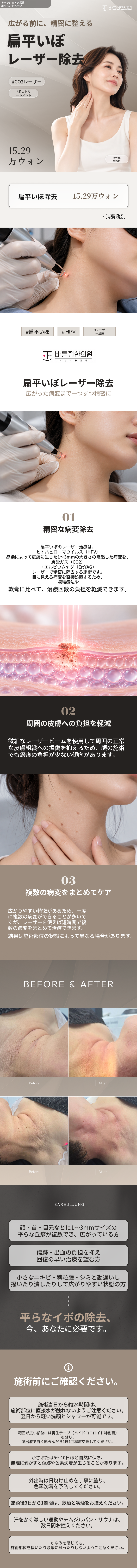 扁平いぼのレーザー除去