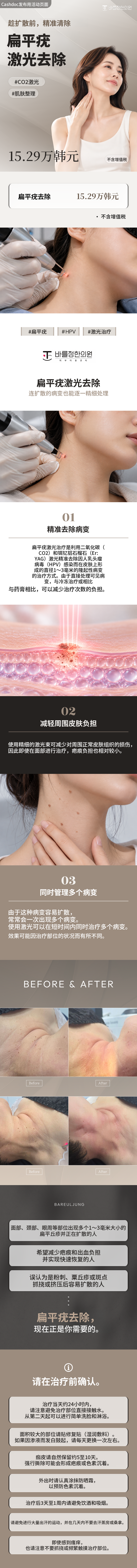 扁平疣激光去除