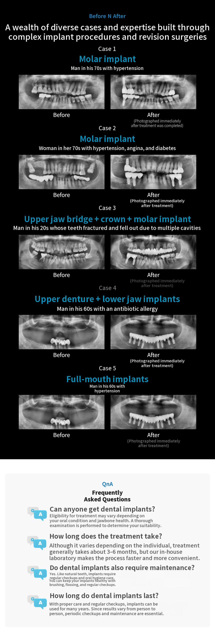Genuine Korean-made Osstem Dental Implant 390,000 won💙