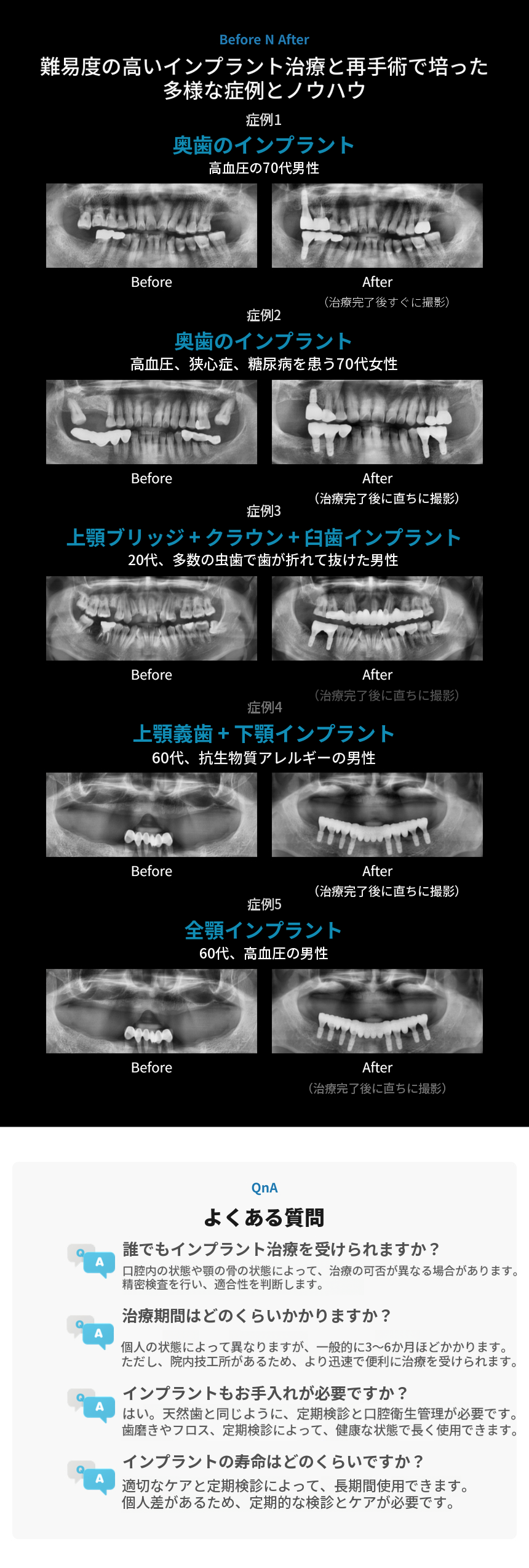 国産正規品 オステムインプラント 39万ウォン💙