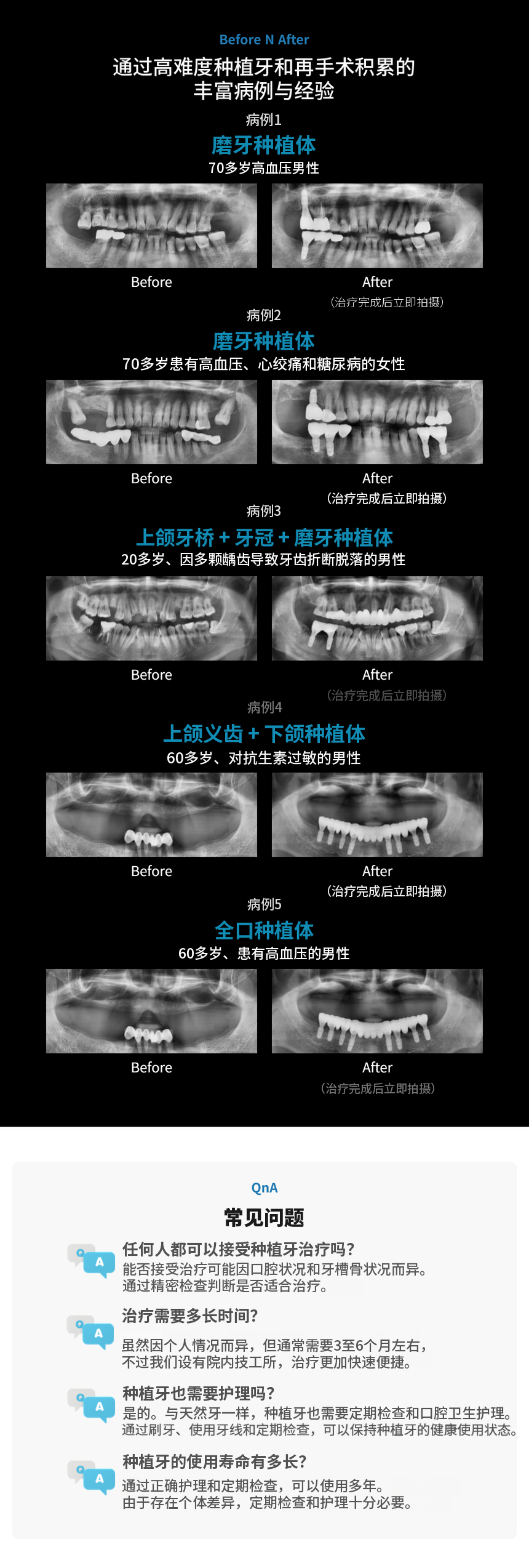 国产正品奥齿泰种植牙39万韩元💙