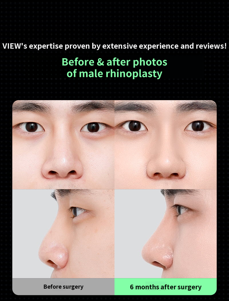 ❤️View❤️Male Nose Surgery