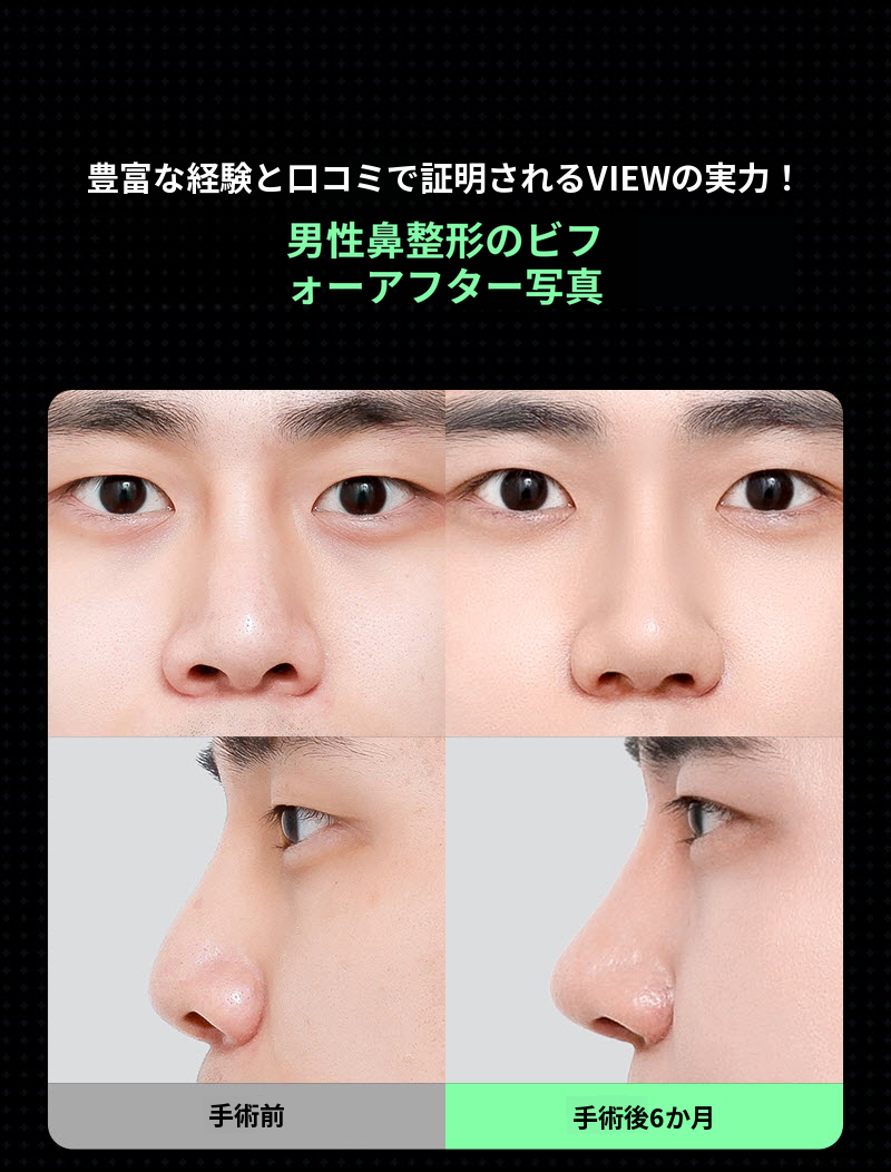 ❤️ビュー❤️男性の鼻整形