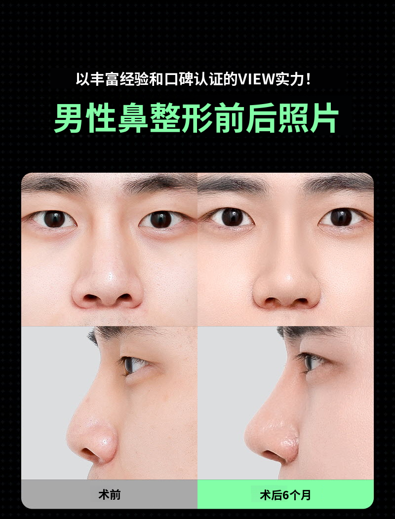 ❤️视图❤️男士鼻整形
