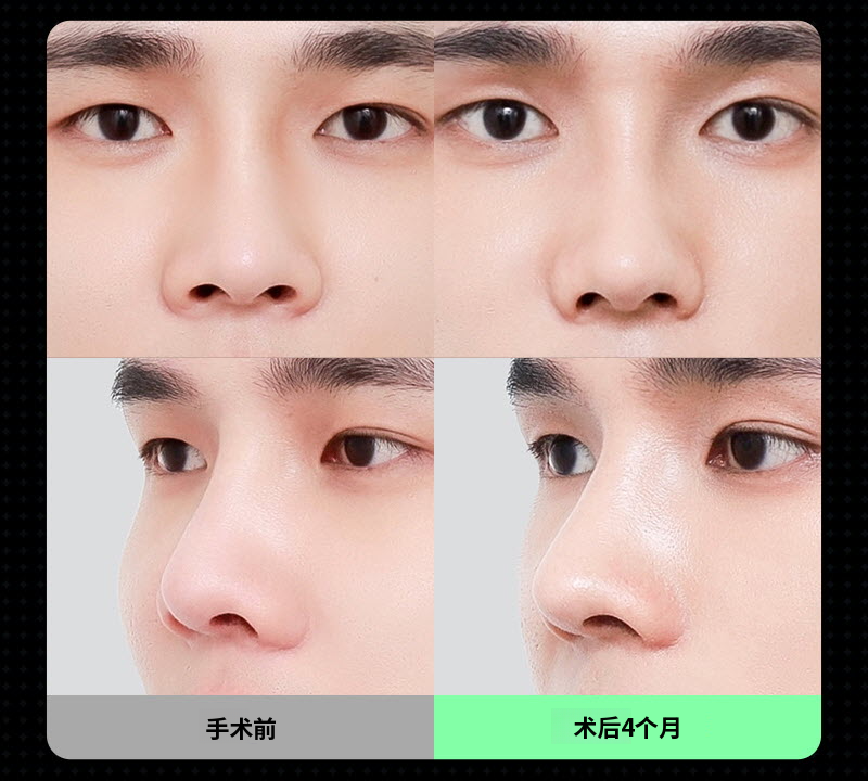 ❤️视图❤️男士鼻整形