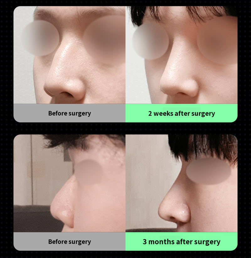 ❤️View❤️Male Nose Surgery