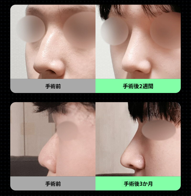 ❤️ビュー❤️男性の鼻整形
