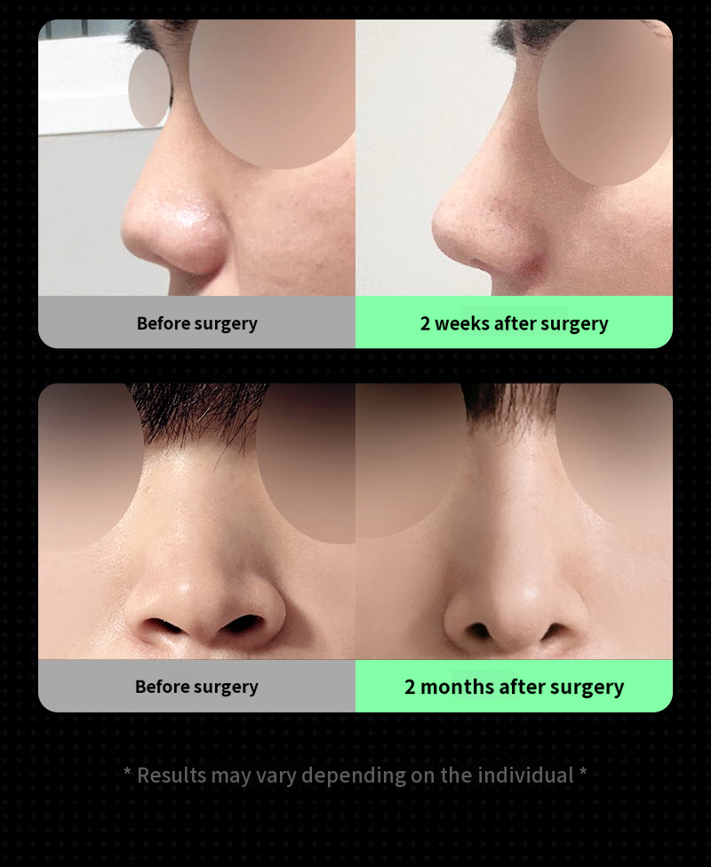 ❤️View❤️Male Nose Surgery