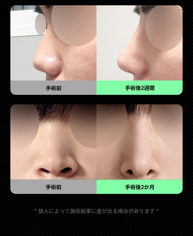 ❤️ビュー❤️男性の鼻整形