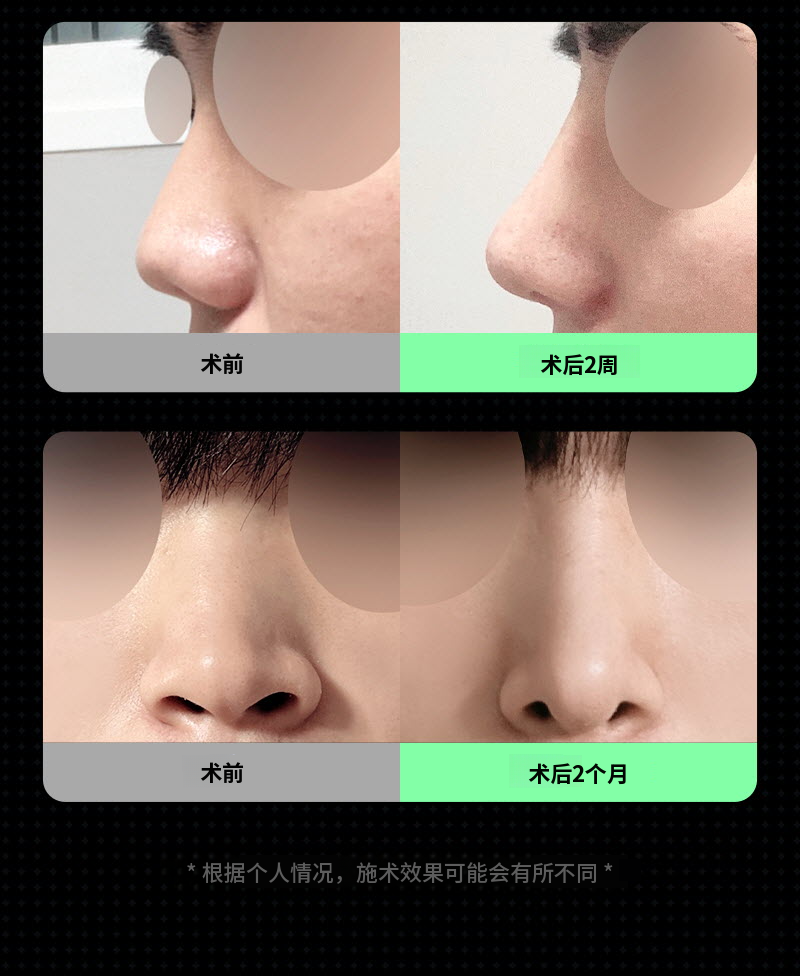 ❤️视图❤️男士鼻整形