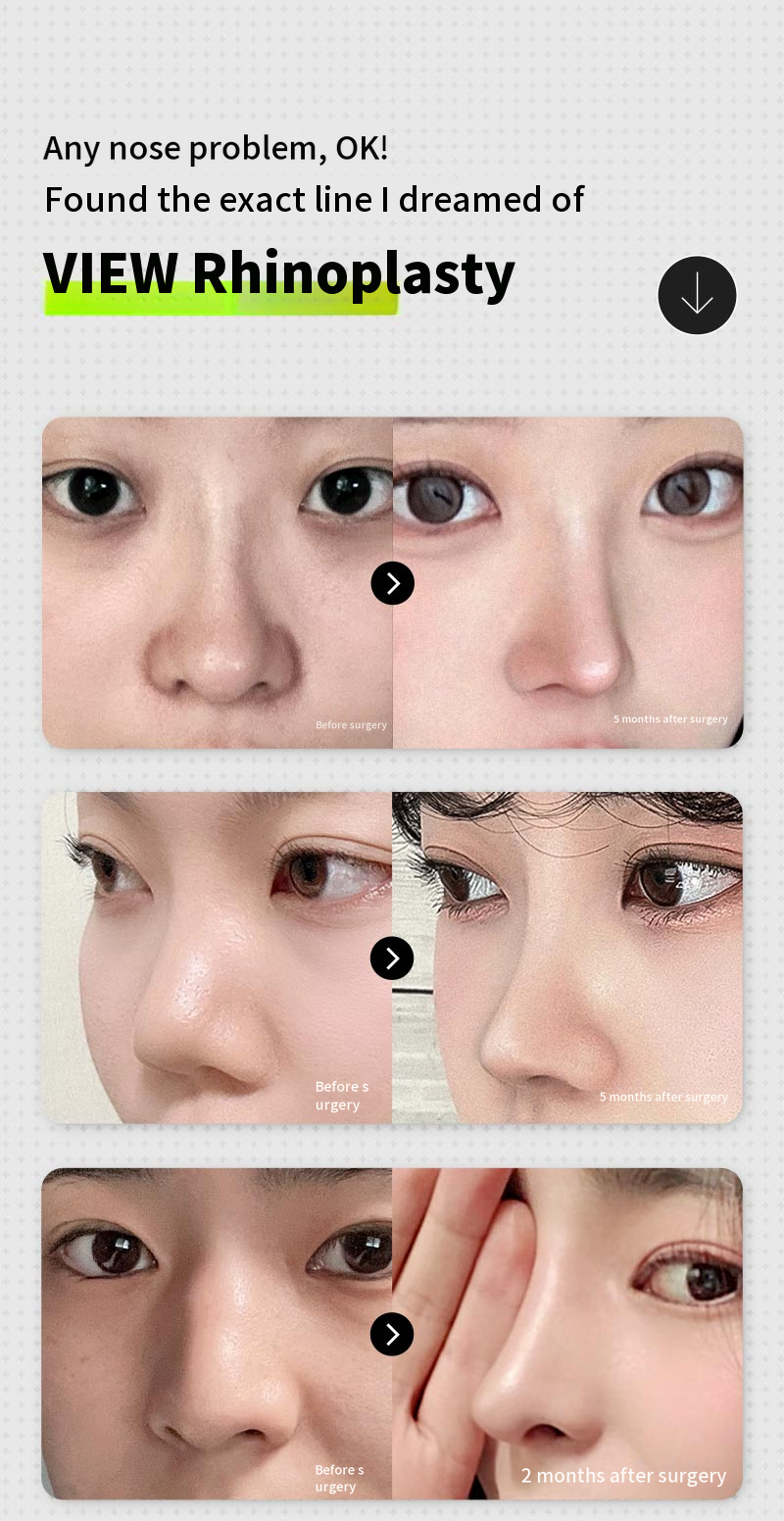 ❤️View❤️ Nose Revision Surgery