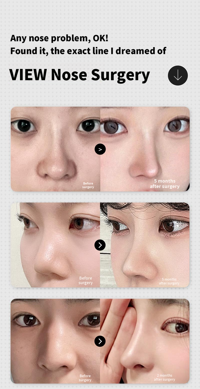 ❤️View❤️Rhinoplasty