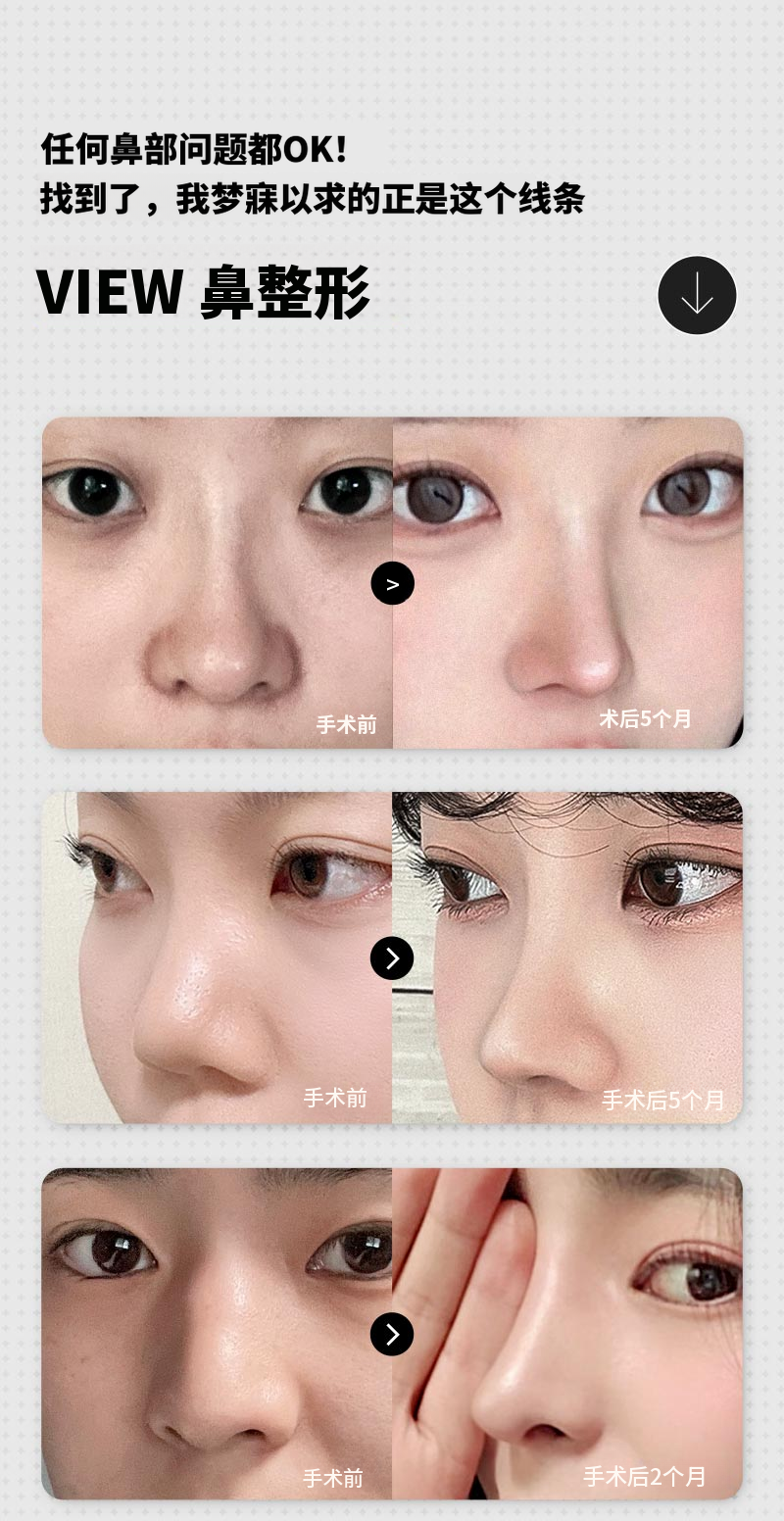 ❤️视❤️鼻再手术