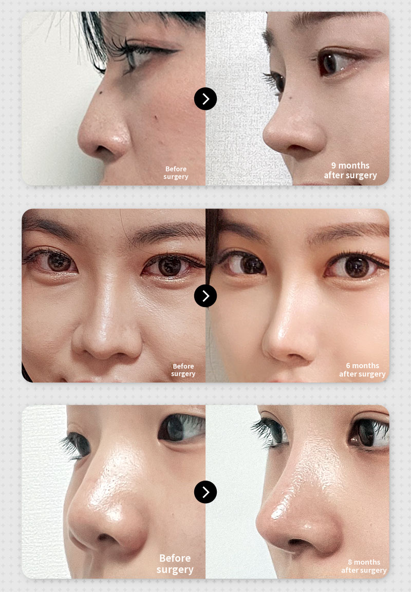 ❤️View❤️Rhinoplasty