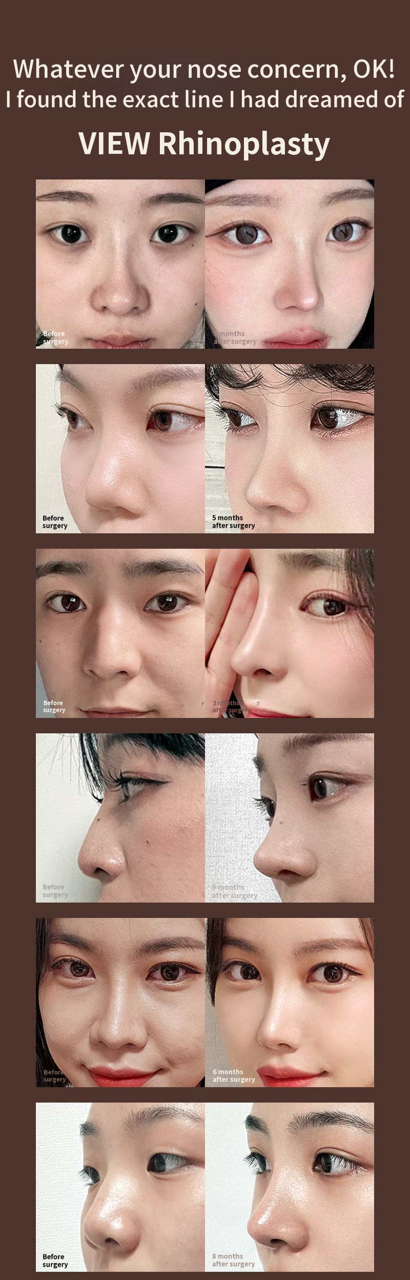 ❤️View❤️ Revision Rhinoplasty