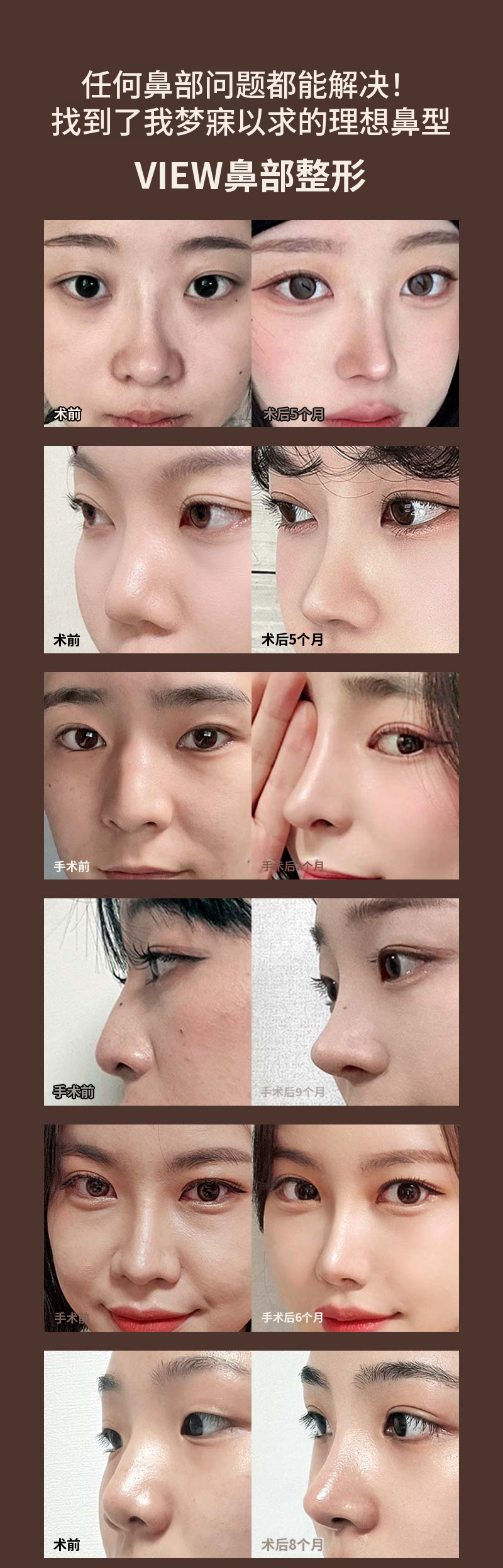❤️VIEW❤️鼻部修复手术
