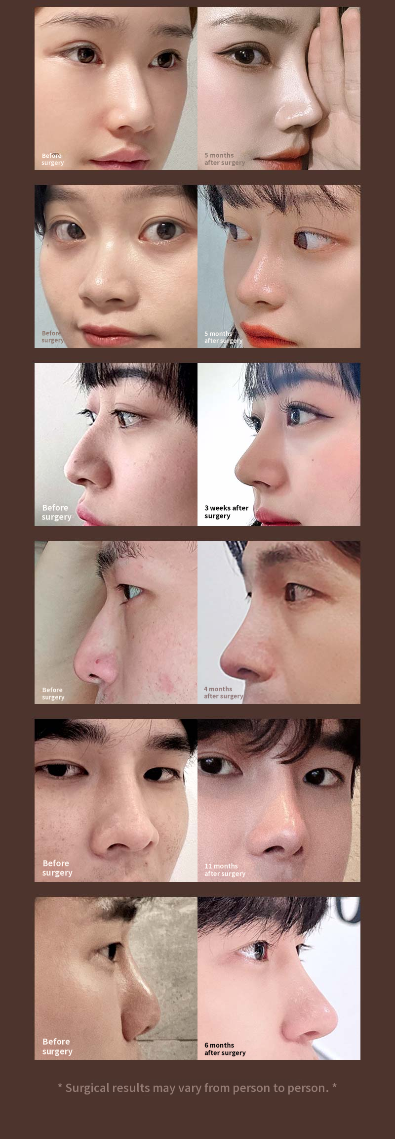❤️View❤️ Revision Rhinoplasty