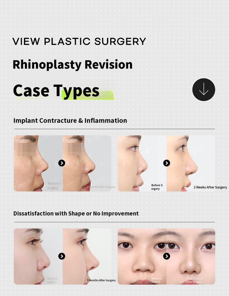 ❤️View❤️ Nose Revision Surgery