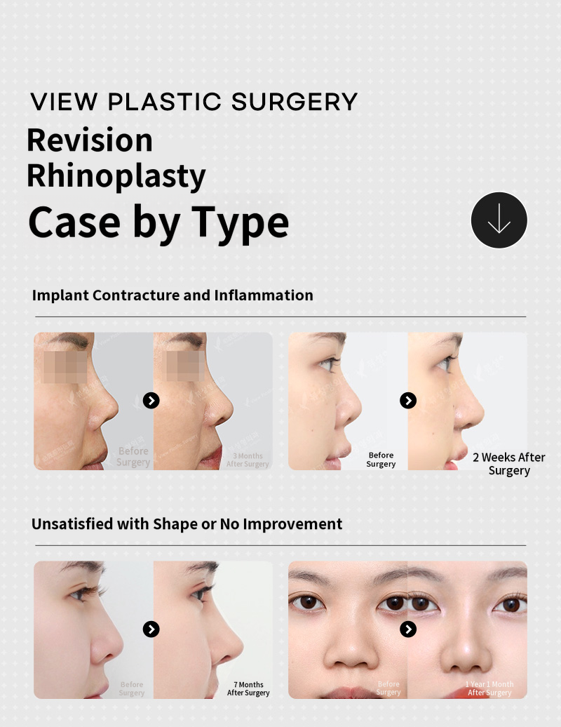 ❤️View❤️Rhinoplasty