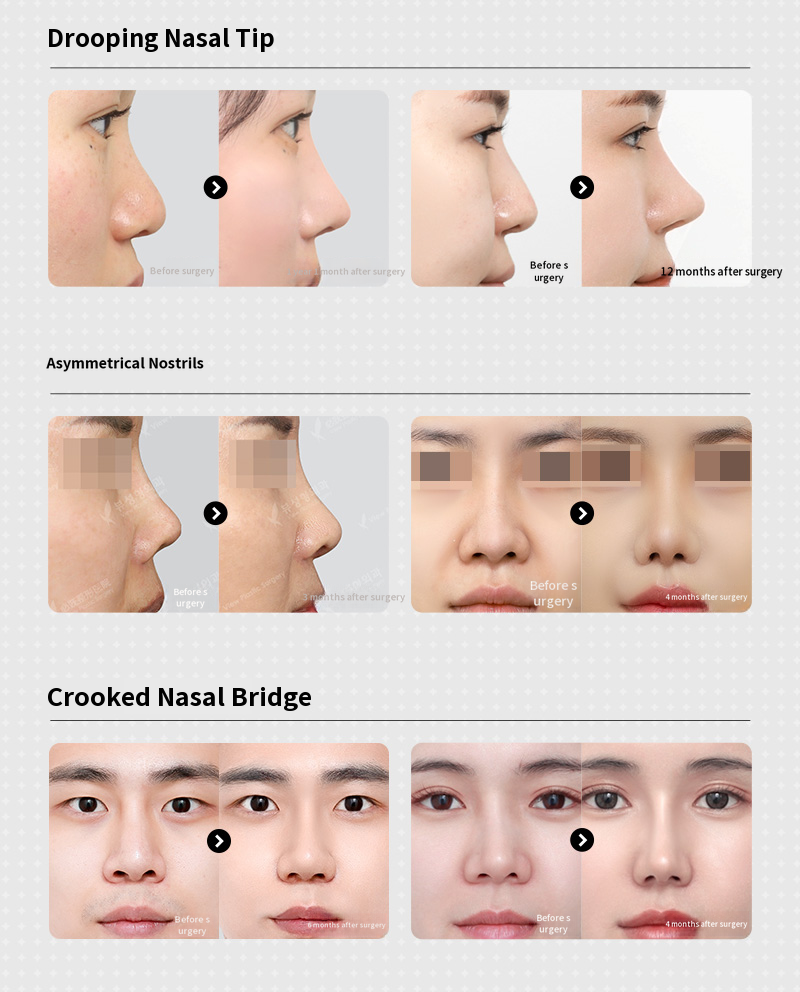 ❤️View❤️ Nose Revision Surgery