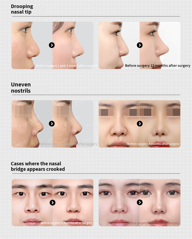 ❤️View❤️Rhinoplasty
