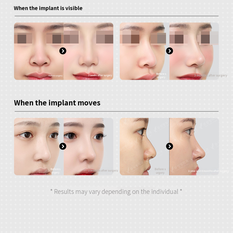 ❤️View❤️ Nose Revision Surgery
