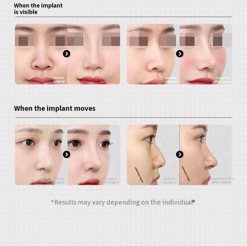 ❤️View❤️Rhinoplasty