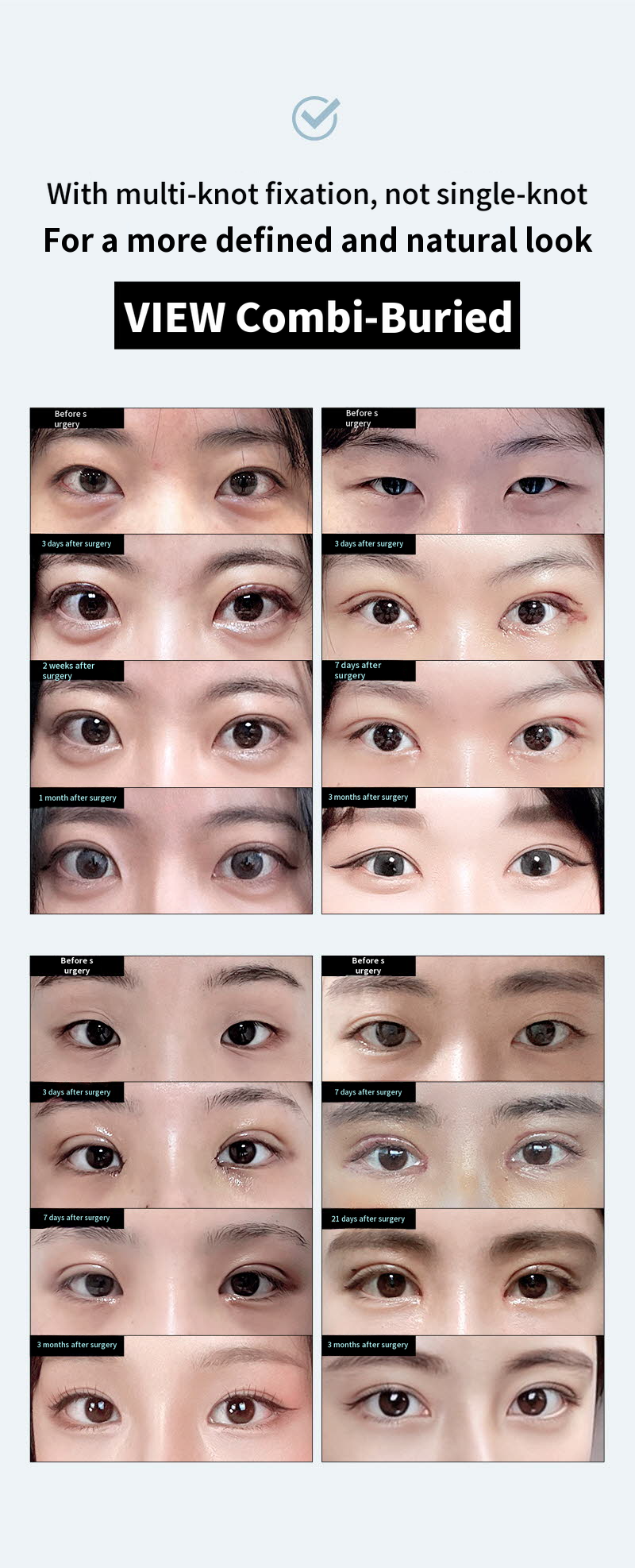 ❤️View❤️ Eye Enhancement Surgery